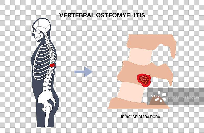 椎骨骨髓炎海报图片素材