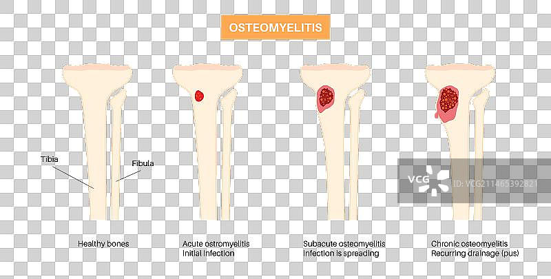胫骨骨髓炎图片素材