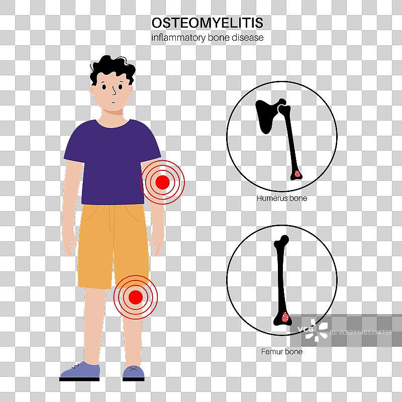 儿童骨髓炎图片素材