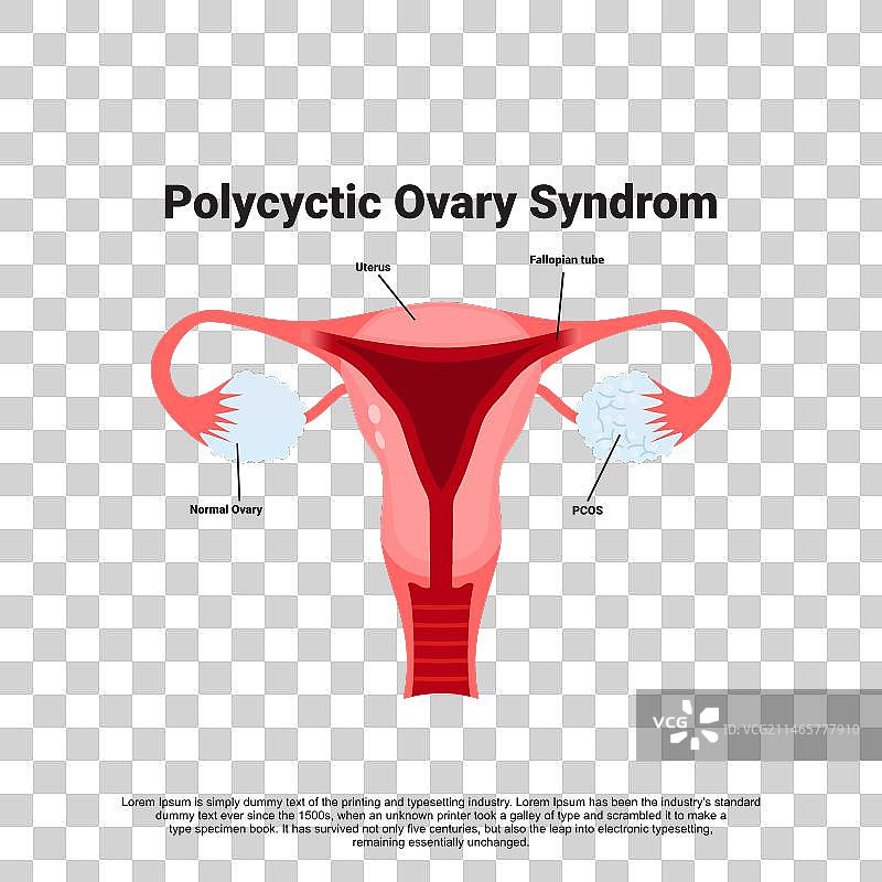 多囊卵巢综合征图片素材