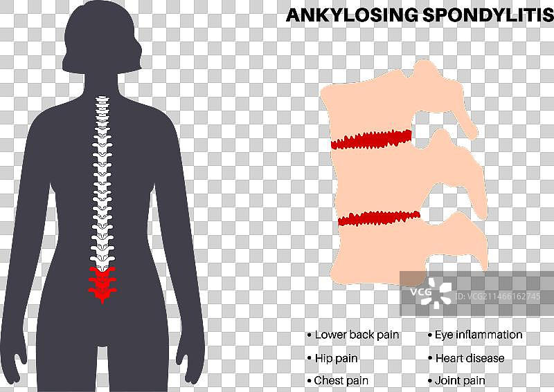 强直性脊柱炎疾病图片素材