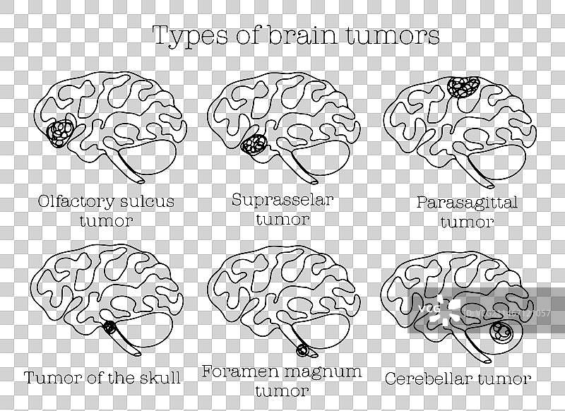 脑肿瘤类型单线图图片素材