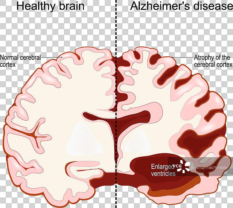 健康的大脑与阿尔茨海默病图片素材