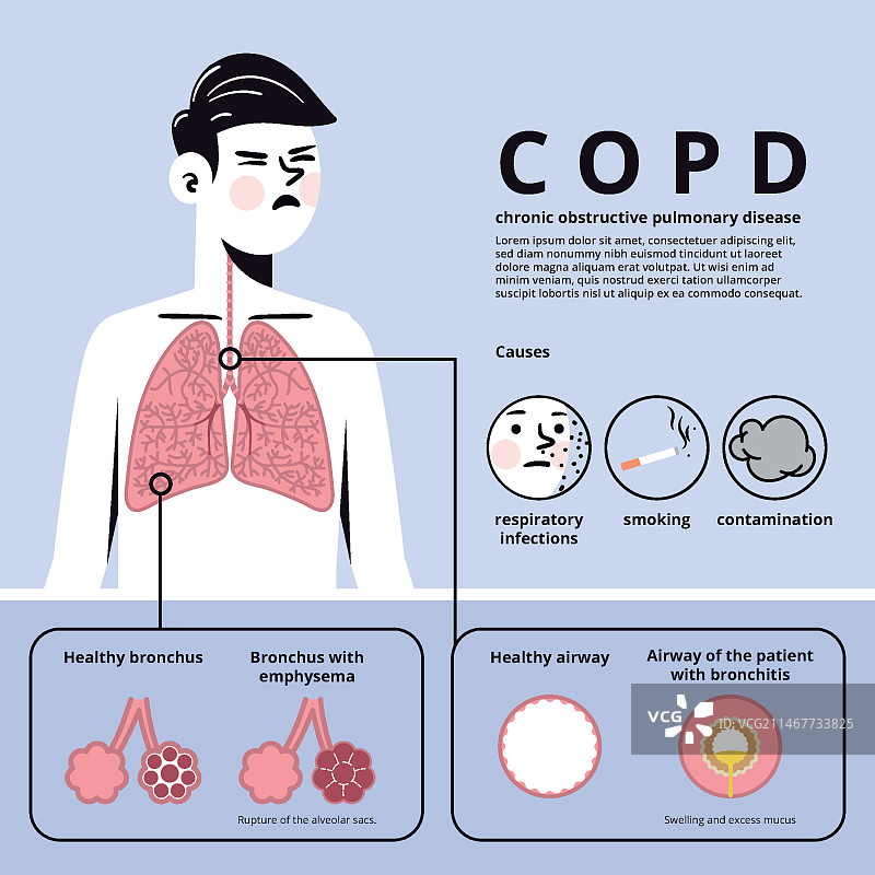手绘慢性阻塞性肺病信息图图片素材
