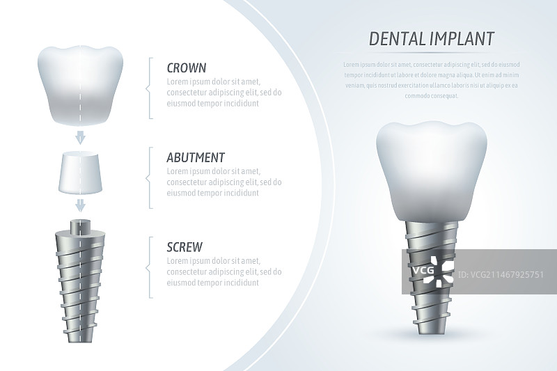 医疗信息图表模板和牙科植入图片素材