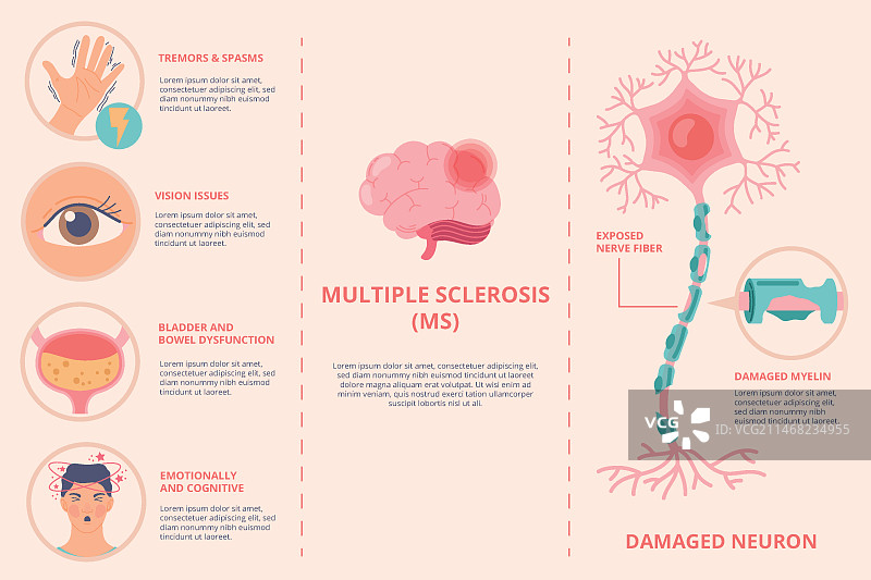 手绘扁平风格多发性硬化症信息图图片素材