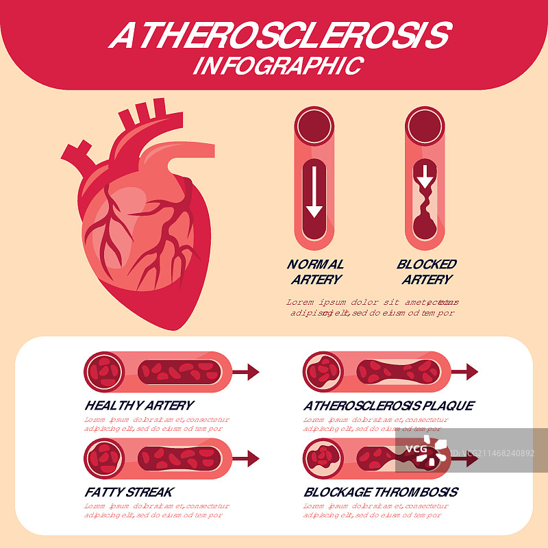 扁平化设计的血液信息图概念图片素材