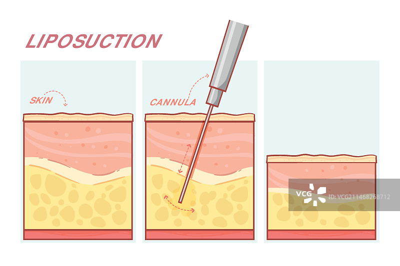 手绘扁平设计抽脂信息图图片素材