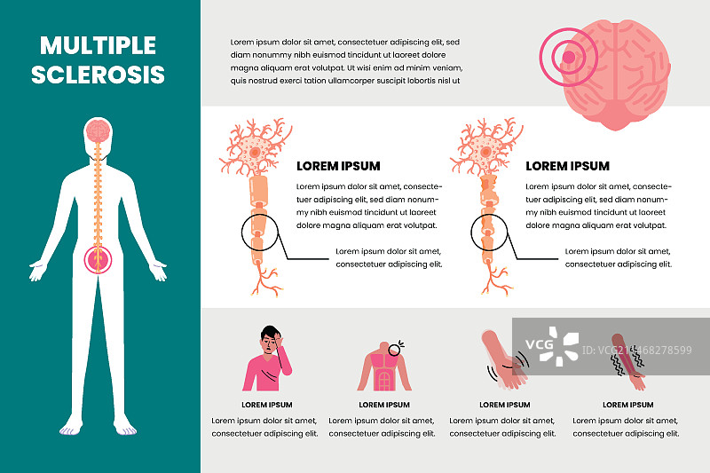 手绘扁平风格多发性硬化症信息图图片素材