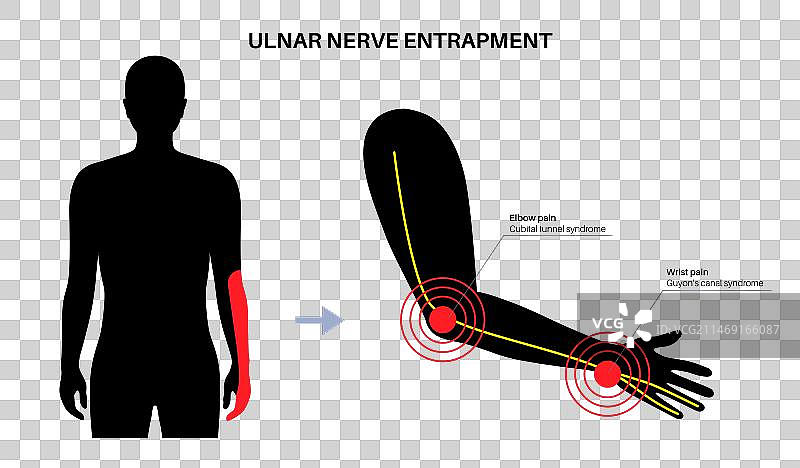 尺神经卡压图片素材
