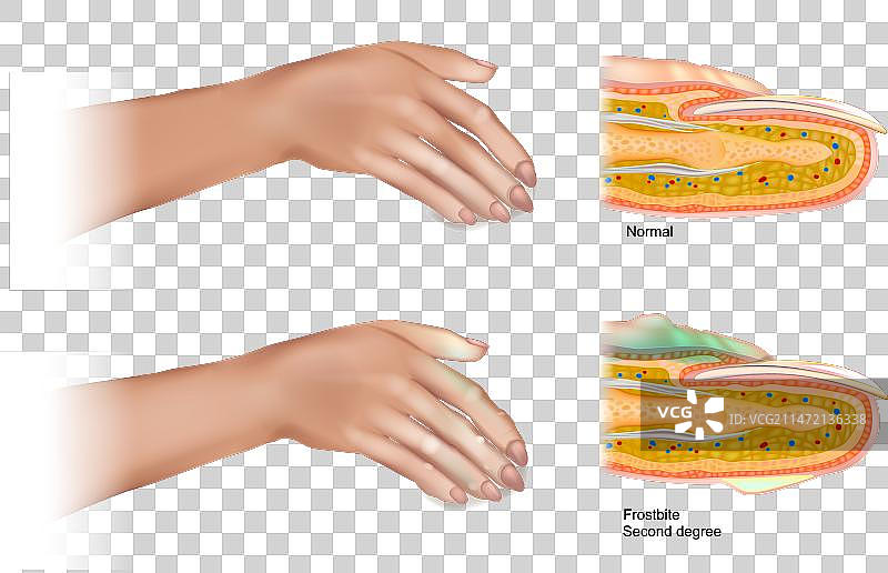 二度冻伤图片素材