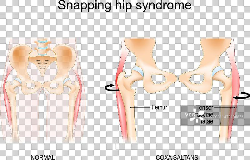弹响髋综合征图片素材