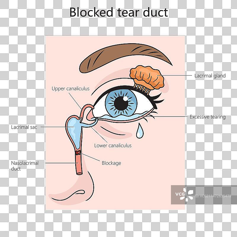 泪道阻塞图医学图片素材