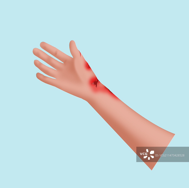 擦伤刀伤人体疾病伤痛伤害皮肤表皮细菌感染病毒危险危机身体健康卫生糜烂溃烂科普插画图片素材