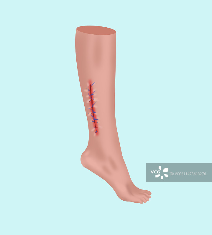 受伤伤口缝合痊愈人体疾病伤痛伤害皮肤表皮细菌感染病毒危险危机身体健康卫生糜烂溃烂科普插画图片素材