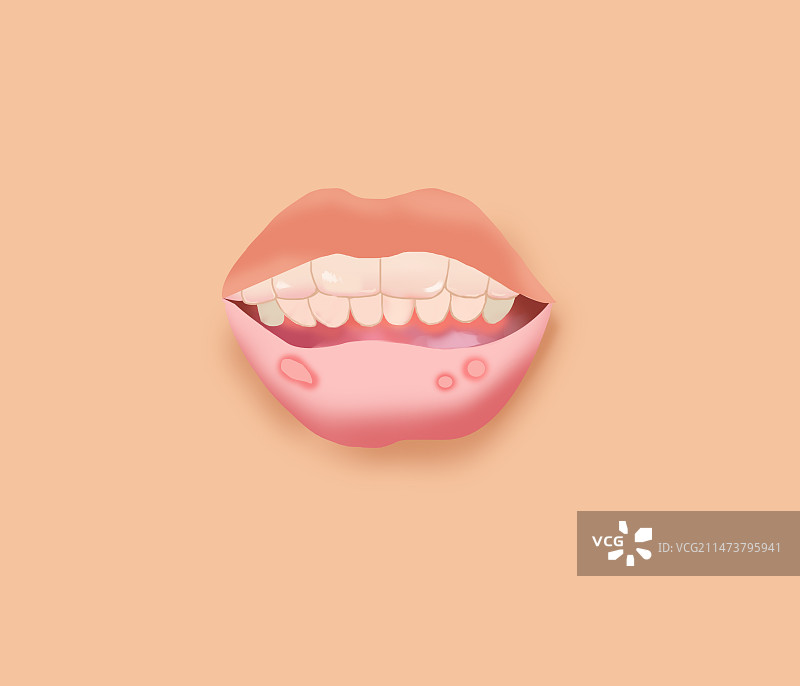 口腔溃疡嘴巴嘴角发炎人体疾病伤痛伤害皮肤表皮细菌感染病毒危险危机身体健康卫生糜烂溃烂科普插画图片素材