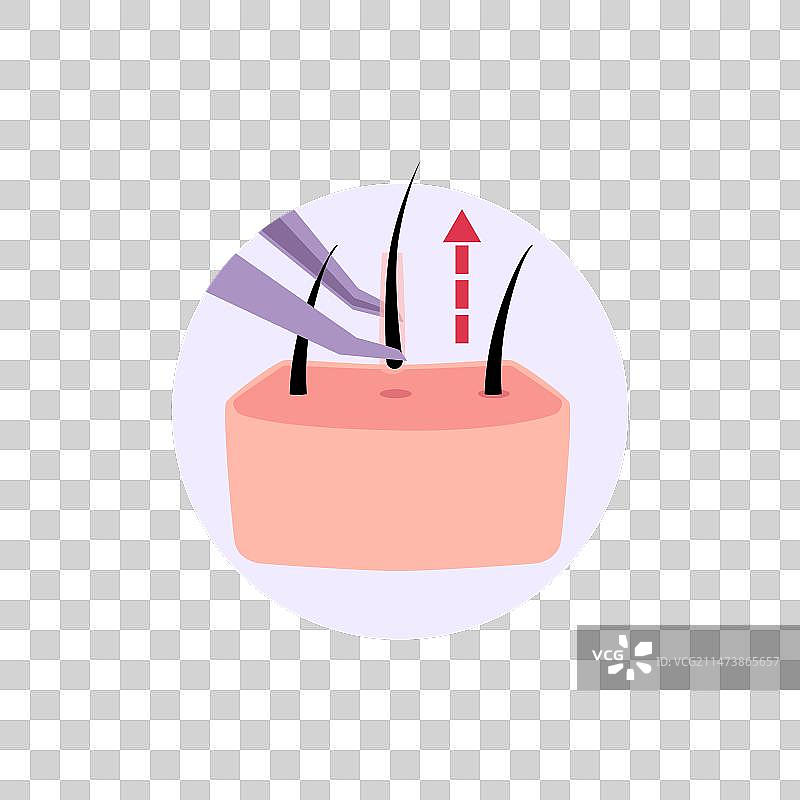 用镊子提取毛囊单位图片素材