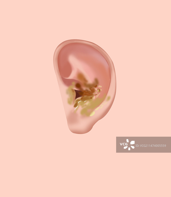 医疗卫生耳朵发炎炎症流脓溃烂糜烂耳屎科普插画图片素材