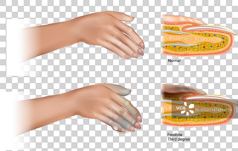 发生的三度冻伤图片素材