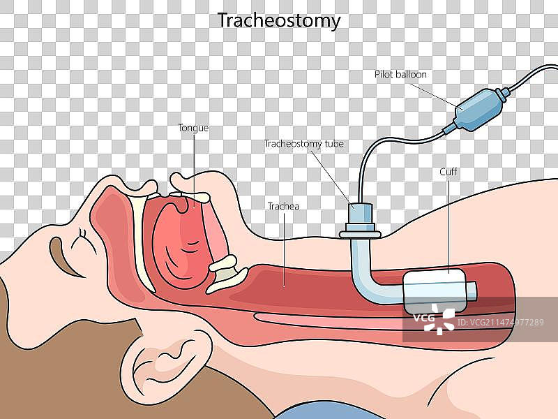 气管切开术结构图医学图片素材