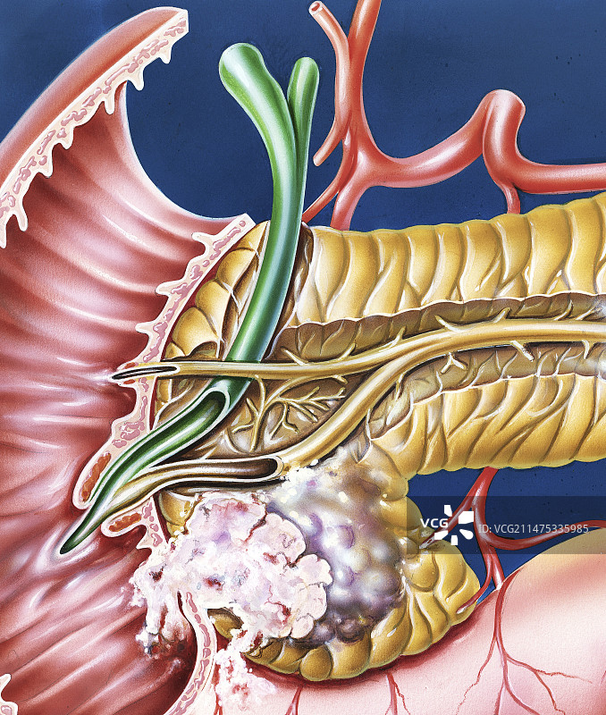 胰腺癌示意图图片素材