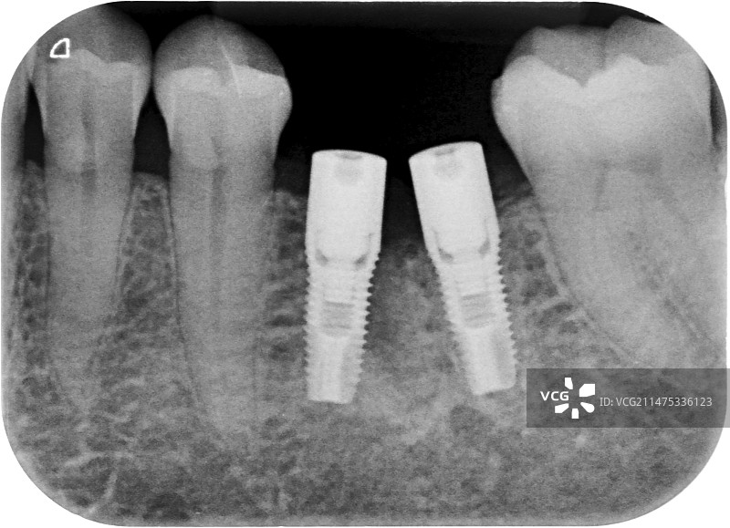 拔牙后的牙科植入物X光片图片素材