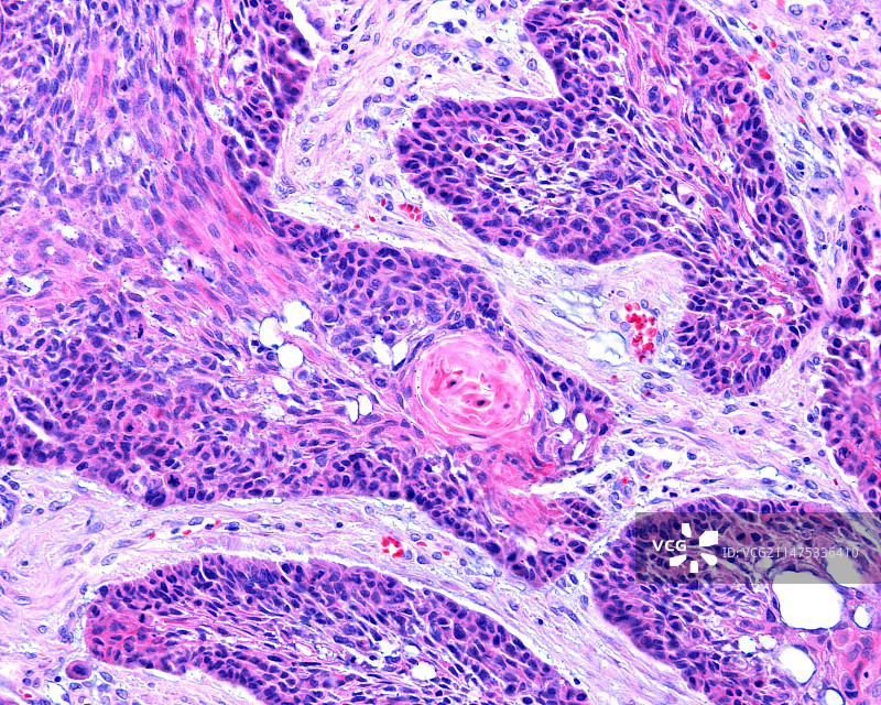 喉鳞状细胞癌显微照片图片素材