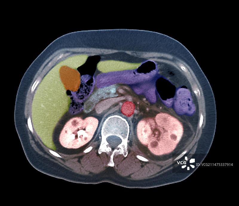 肾盂肾炎轴位CT扫描图片素材