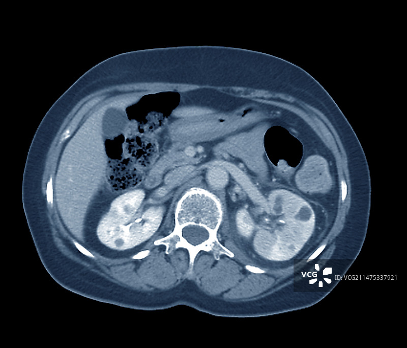 肾盂肾炎轴位CT扫描图片素材