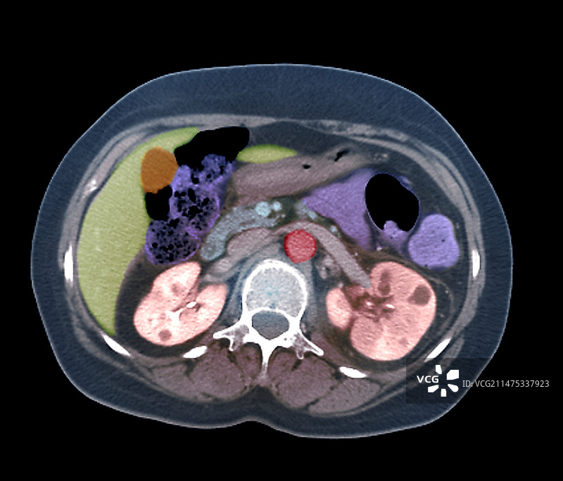 肾盂肾炎轴位CT扫描图片素材