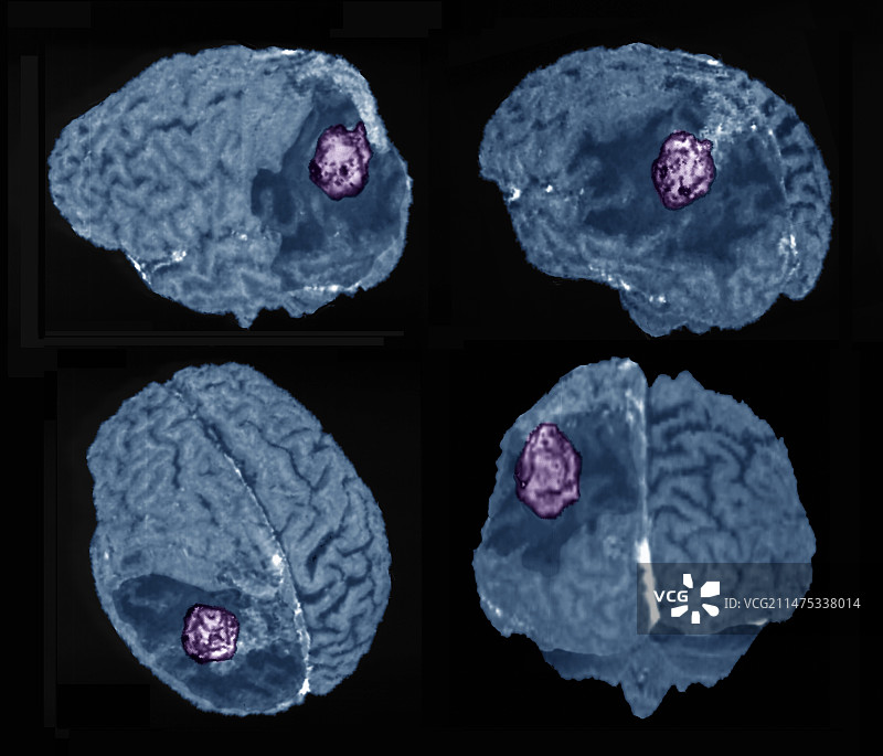复发性神经胶质瘤脑肿瘤3D核磁共振扫描图片素材