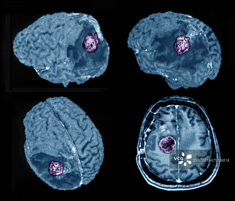 复发性神经胶质瘤脑肿瘤的3D和2D MRI扫描图片素材