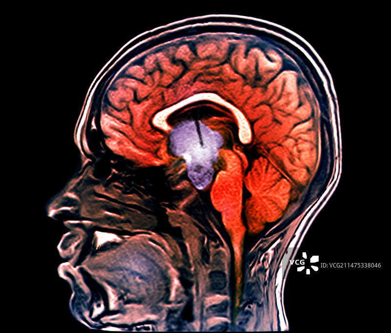 癌症引起脑积水的治疗：核磁共振扫描图片素材