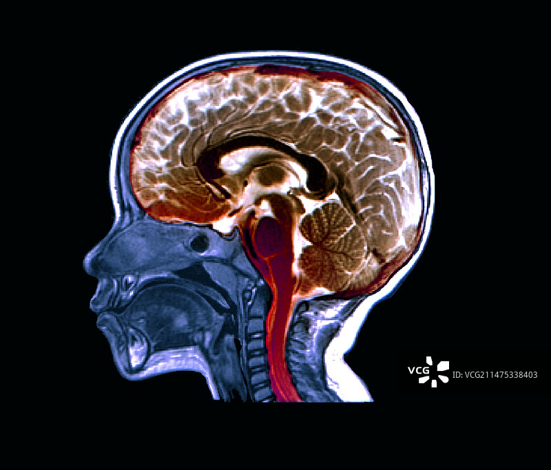 儿童头部和大脑的MRI扫描图片素材