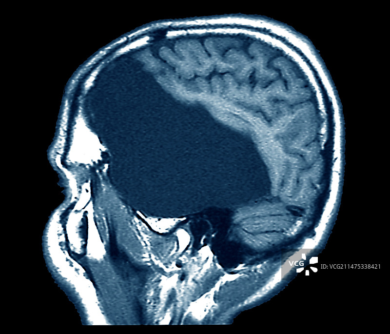 大型蛛网膜囊肿MRI扫描图片素材