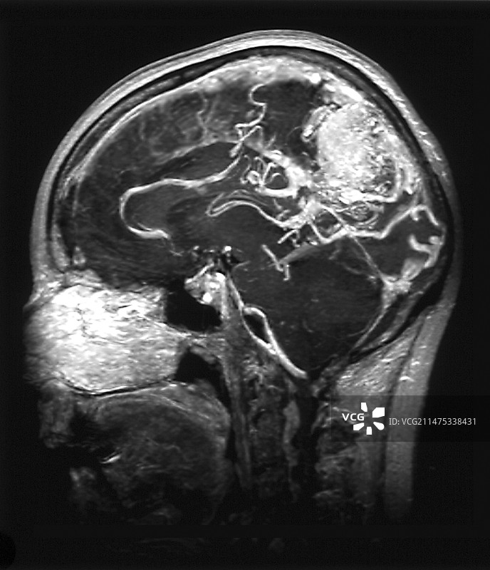 脑动静脉畸形MRA扫描图片素材