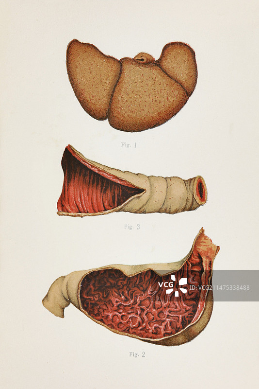 萨纳雷利 19 世纪的钩端螺旋体病研究图片素材