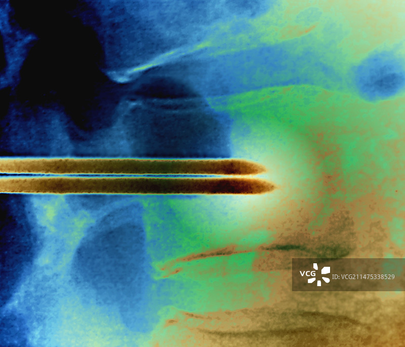 转移性癌症椎体增强术X光片图片素材