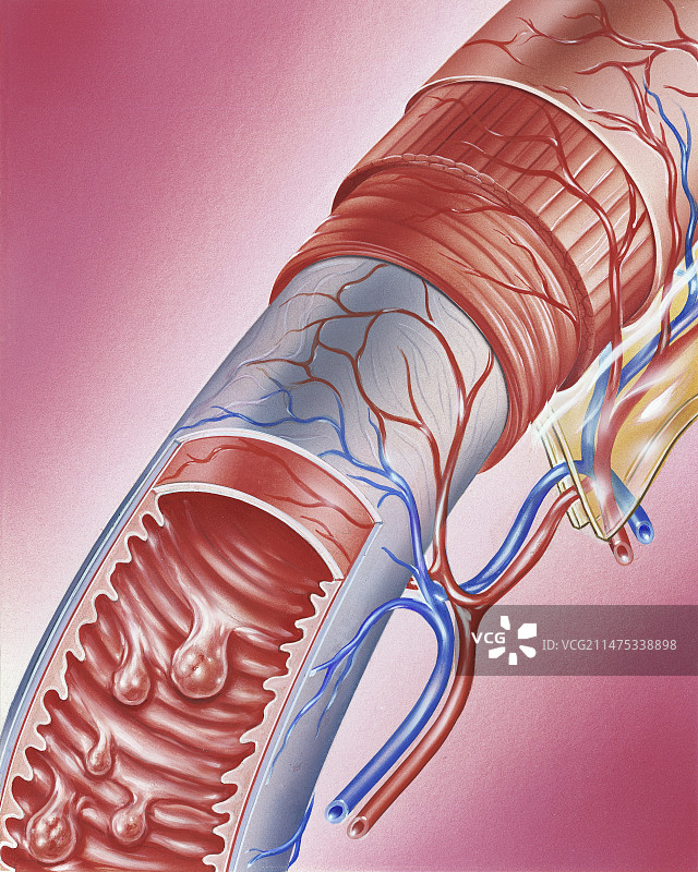 小肠息肉插图图片素材