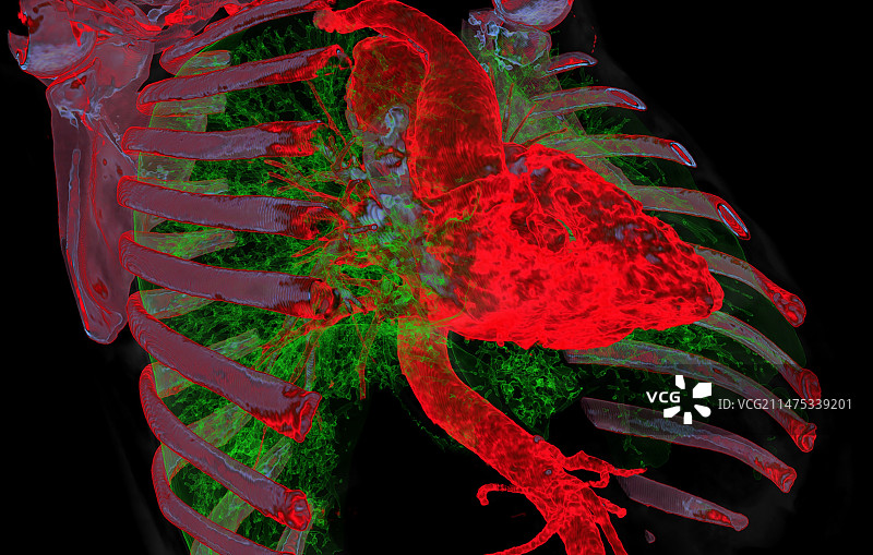 主动脉瘤3D CT扫描图片素材