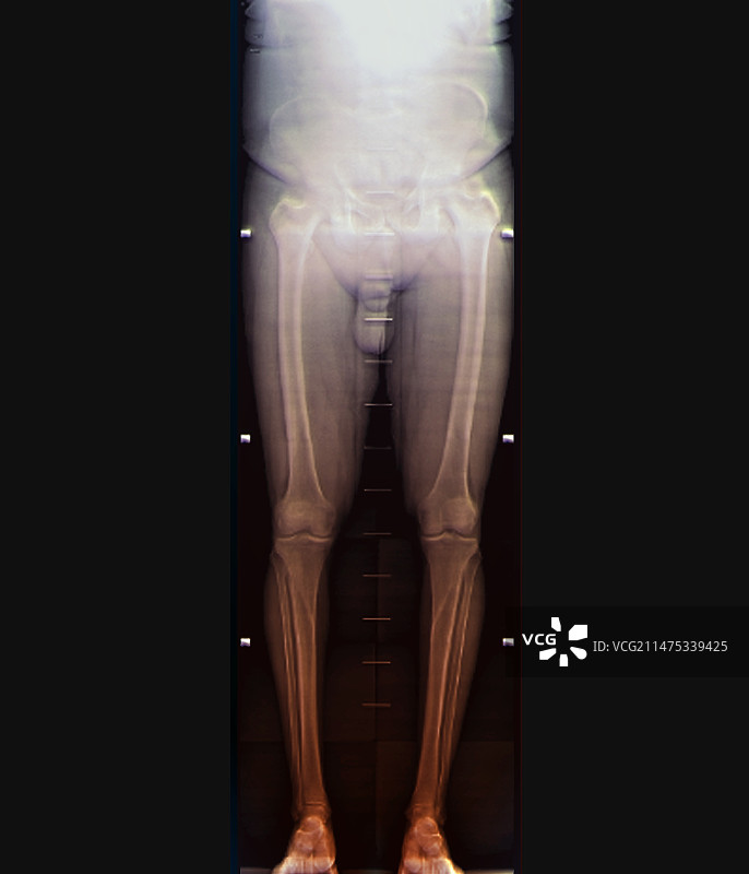 健康的下半身X光片图片素材