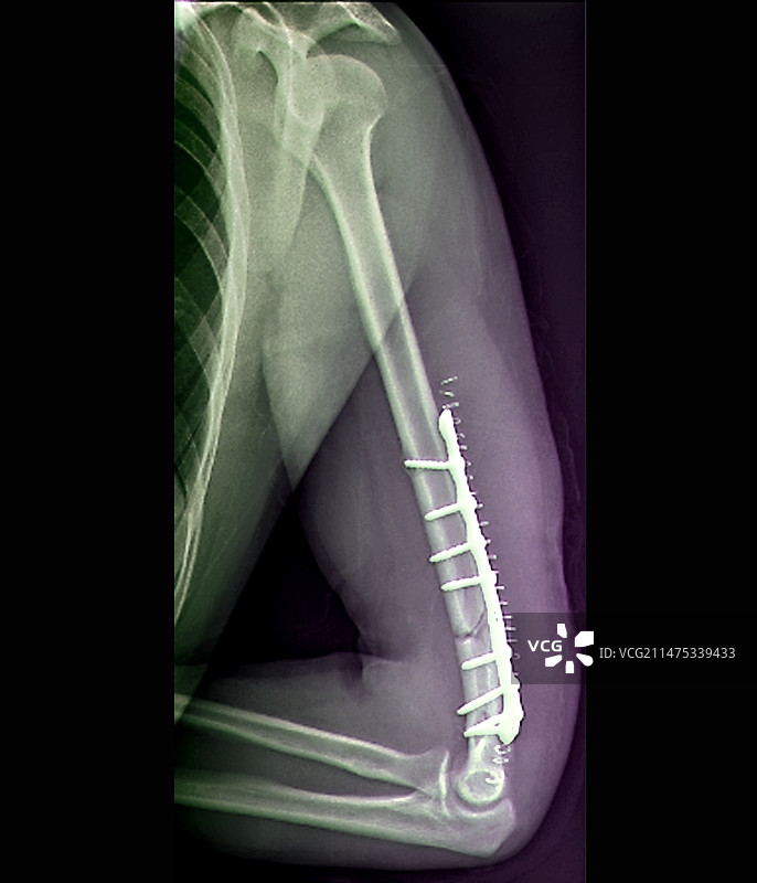 肱骨上端骨折X光片图片素材