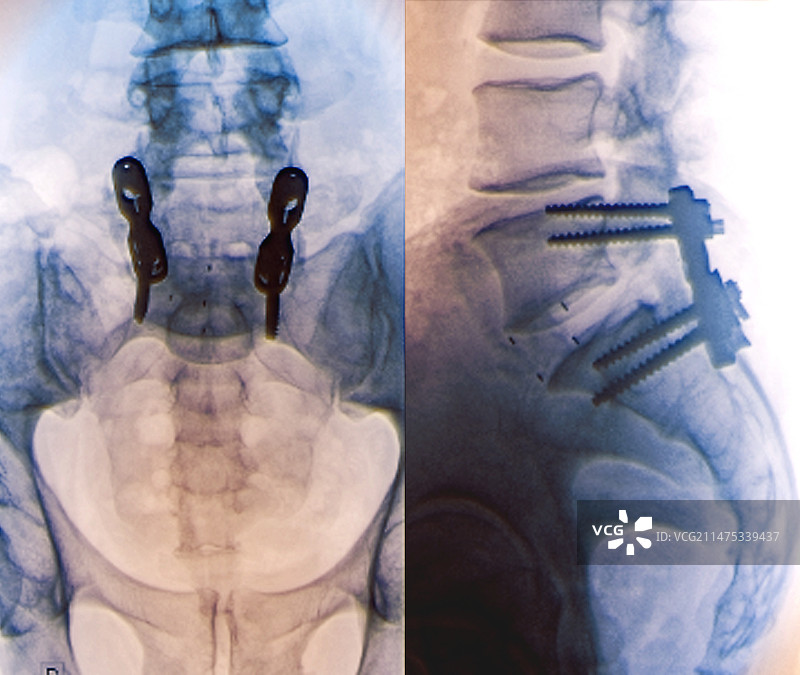 椎间固定X光片图片素材
