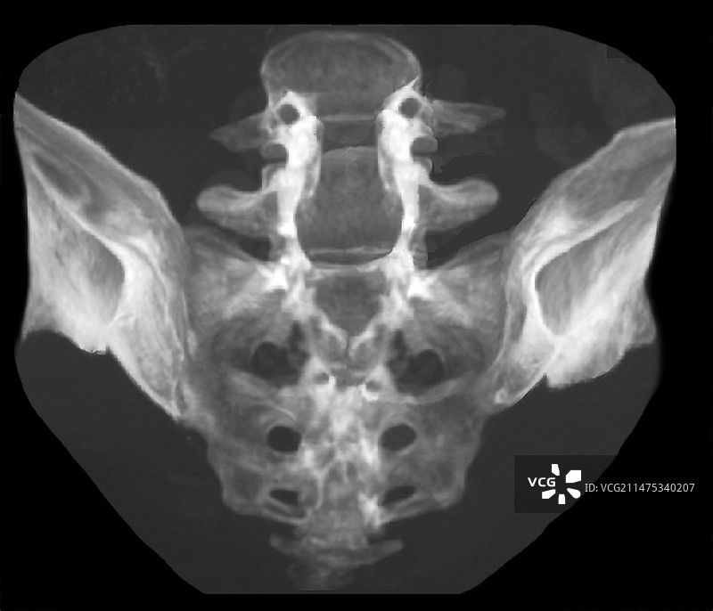 椎板切除术后的骶骨CT扫描图片素材