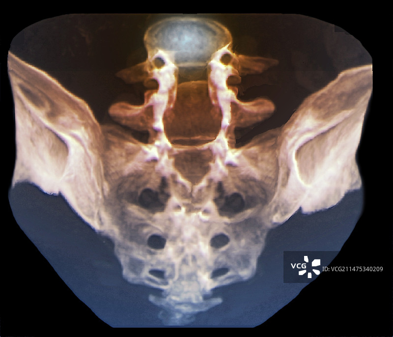 椎板切除术后的骶骨CT扫描图片素材