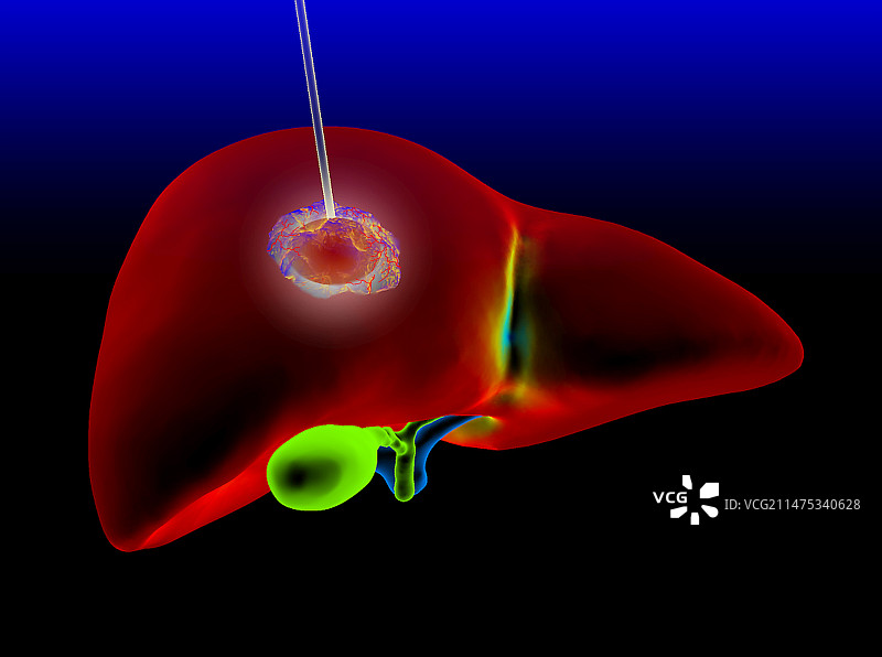 肝癌热消融术示意图图片素材