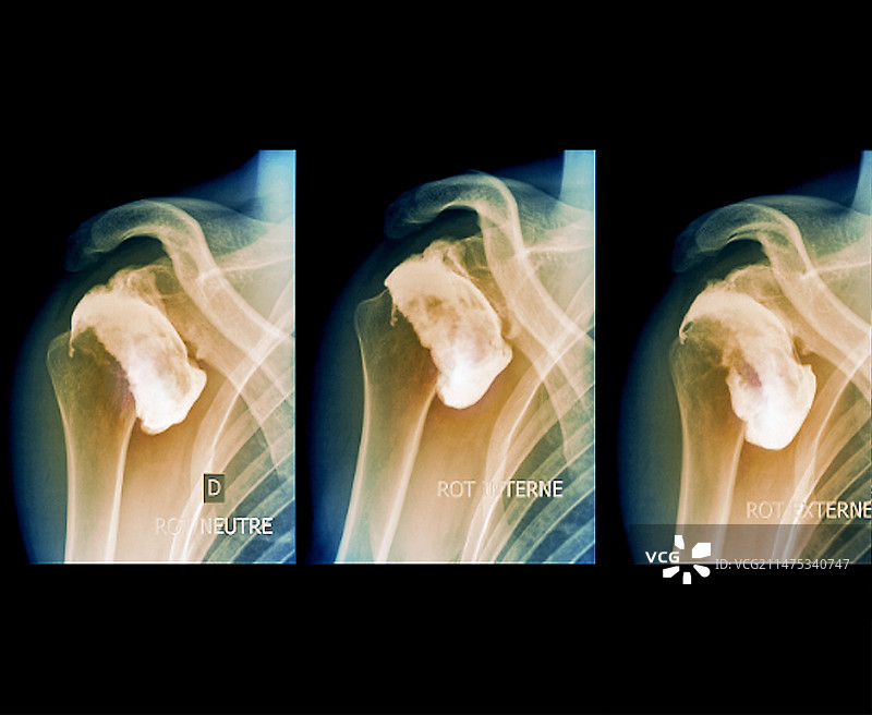 运动损伤中肩关节脱位后的并发症图片素材