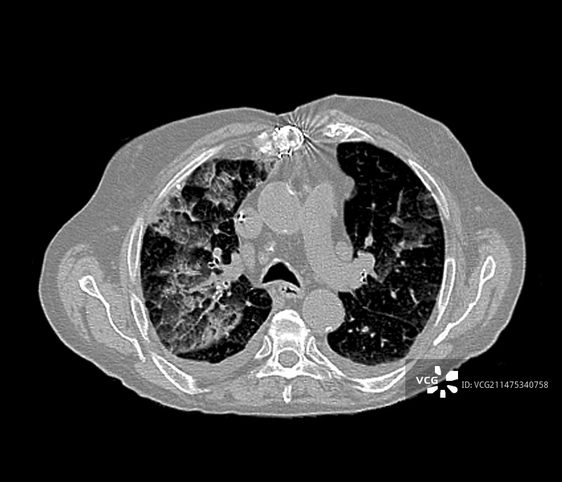心力衰竭CT扫描图片素材
