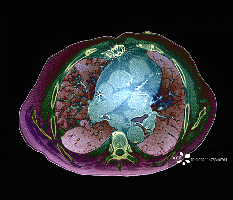 心力衰竭CT扫描图片素材