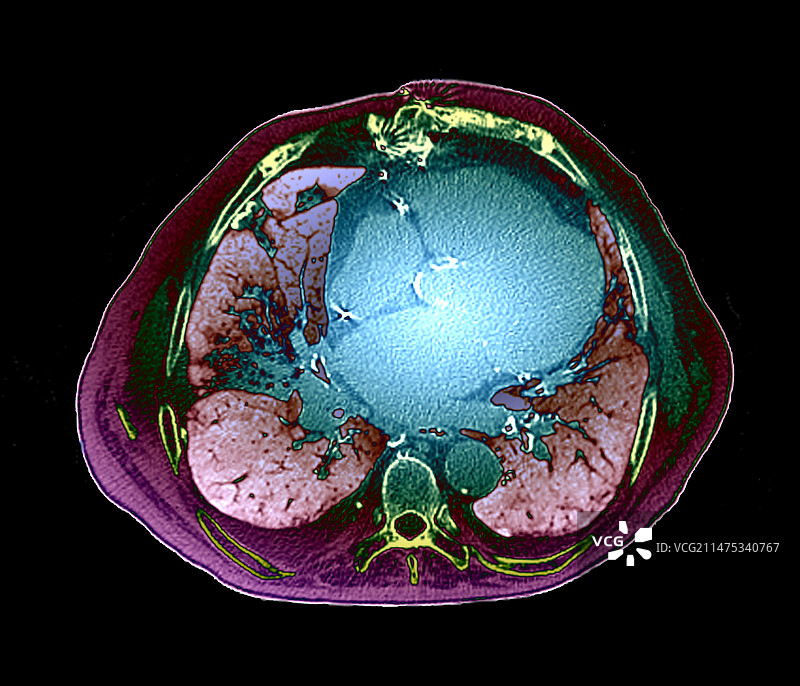 心力衰竭CT扫描图片素材